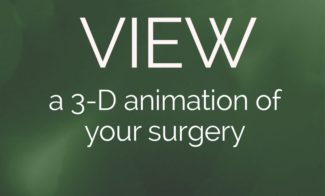 View a 3D animation of your surgery