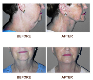 Before and After Face and Neck Lift