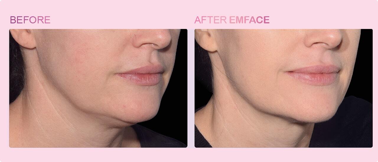 Before and after Emface treatment at Folk Plastic Surgery in Denver