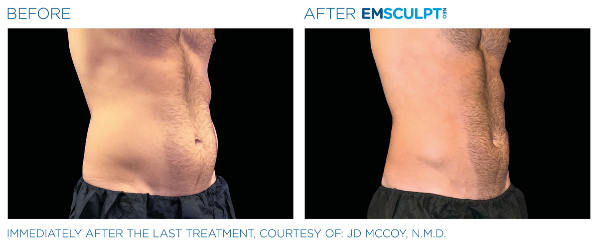 Before and after Emsculpt NEO abdomen treatment on a man