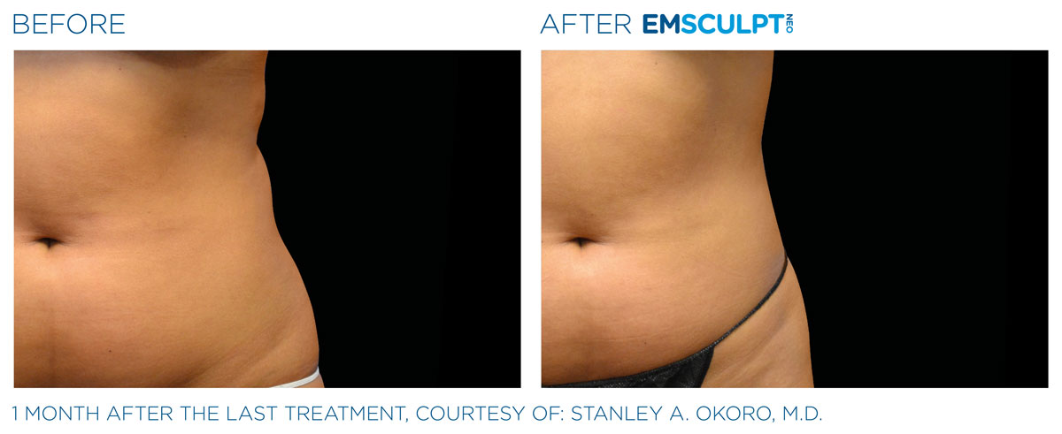 Before and after Emsculpt NEO abdomen treatment on a woman