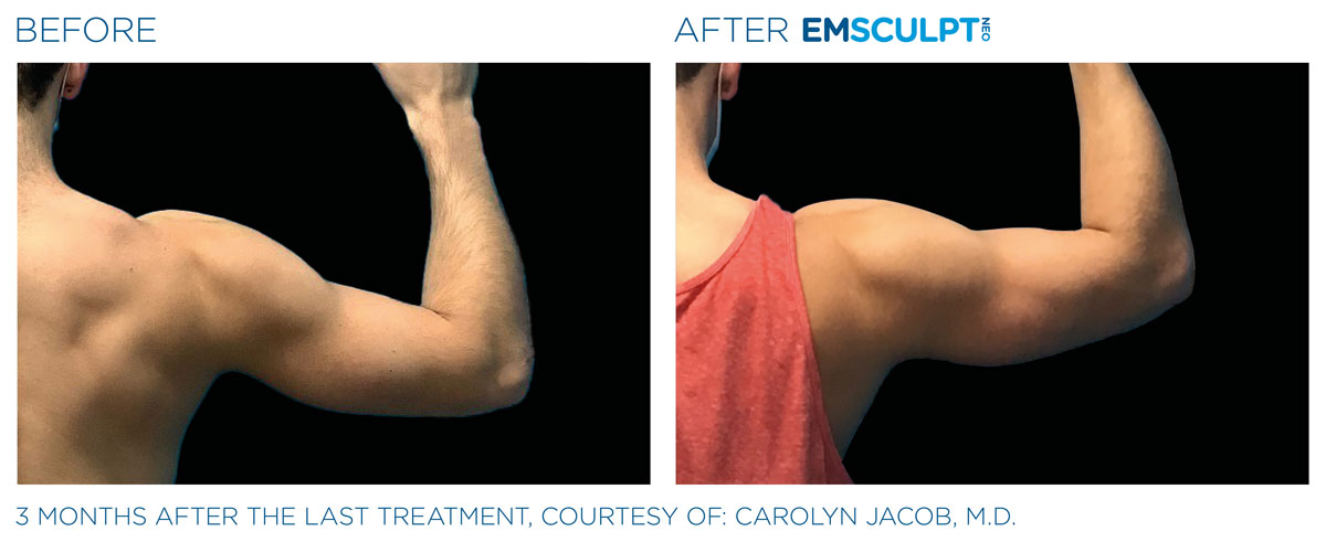 before and after emsculpt neo arm treament for a man