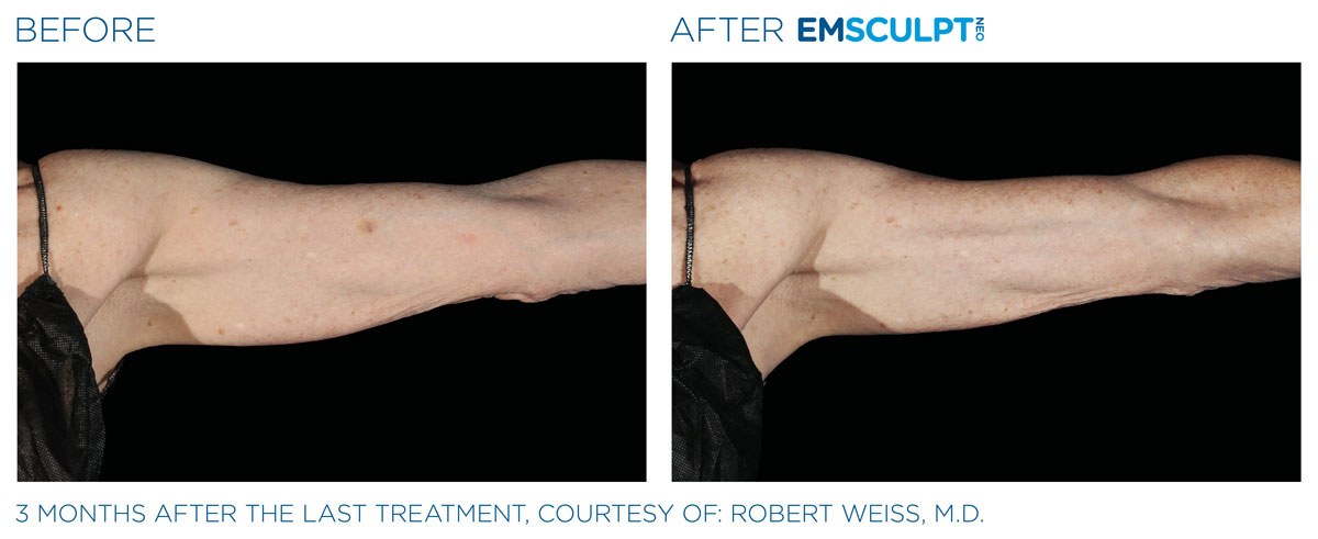 before and after emsculpt neo arm treament for a woman