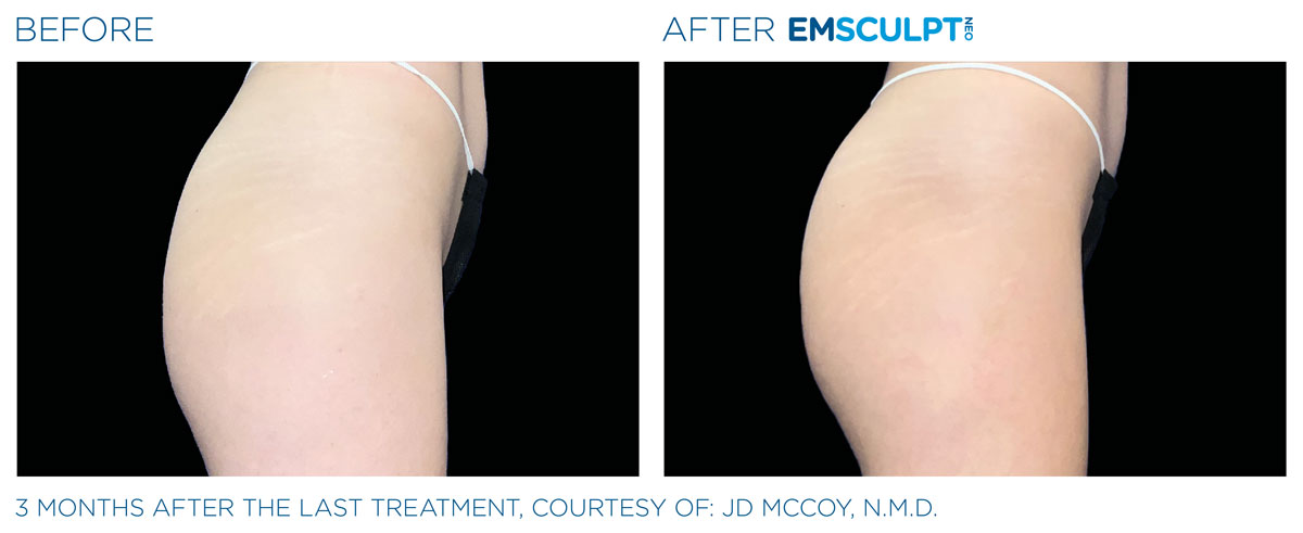 before and after emsculpt neo butt toning treament